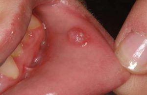 Άφθες. Άμεση Αντιμετώπιση με Φυσικές Μεθόδους