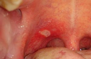 Καταπολεμίστε τις άφθες χωρίς φάρμακα