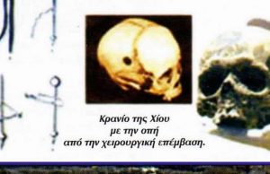 Λεπτή Εγχείρηση Εγκεφάλου στην Αρχαία Χίο το 250 π.Χ.