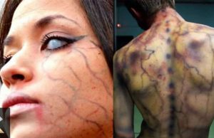 Άνθρωποι που τους χτύπησε κεραυνός