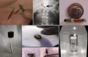 Βρέθηκαν Εξωγήινα Εμφυτεύματα Μέσα σε Ανθρώπους