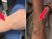 Γιατί Όλες οι Γυναίκες έχουν μια Φακίδα στο Ίδιο Σημείο του Χεριού τους; Η απάντηση